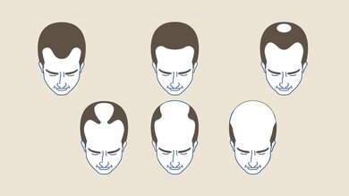Anlagebedingter Haarausfall beim Mann: Erst bilden sich „Geheimratsecken“ und eine „Tonsur“. Später kann sich eine Glatze entwickeln.
