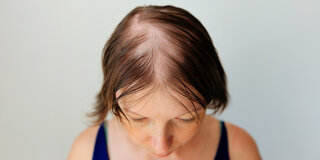 Bei Frauen mit anlagebedingtem Haarausfall lichtet sich das Haar typischerweise entlang des Scheitels.