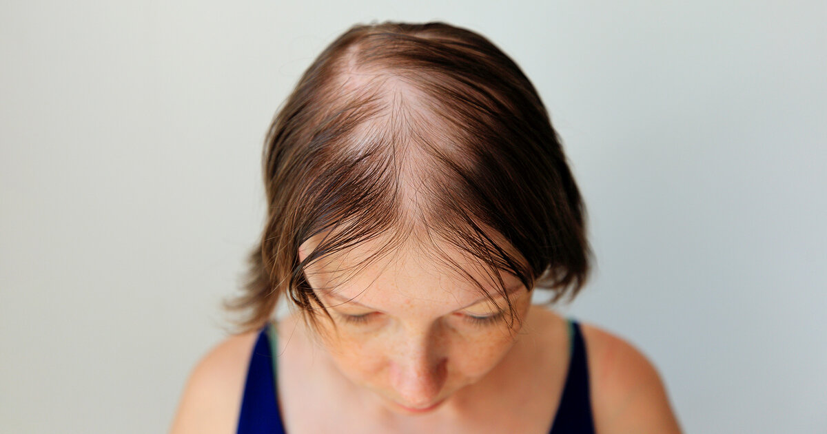 Anlagebedingter Haarausfall Ursachen und Therapie Apotheken Umschau