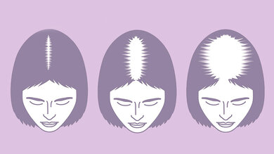 Anlagebedingter Haarausfall bei Frauen: Er äußert sich durch Haarverlust am Scheitel. Dieser ist mitunter so stark ausgeprägt, dass sich eine Glatze bildet.