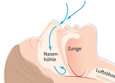 Wenn in Rückenlage die Zunge nach hinten fällt, kann die Engstelle (rot) den Luftstrom (blaue Pfeile) behindern. Die Folge: Schnarchen oder sogar Atemaussetzer