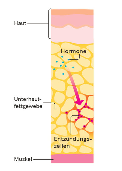 Das Fettgewebe bildet spezielle Hormone, darunter Adipokine und Zytokine. Diese beeinflussen das Lipödem ungünstig. Es kommt zu Entzündungsprozessen und damit verbundenen Schmerzen