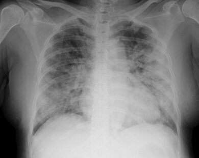 Bei schweren Covid-19-Verläufen ist vor allem die Lunge oft betroffen