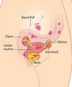 Die Grafik zeigt, wo sich Endometrioseherde zum Beispiel zeigen können