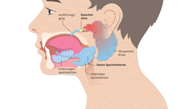 Rund 83 Prozent der Speichelsteine entstehen im Unterkiefer. Aber auch in der Ohr- und Unterzungenspeicheldrüse kommen sie vor