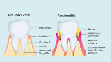 Ausgelöst wird Parodontitis durch Bak­terien in Zahnbelägen. Sie bilden sich auf den Zahnoberflächen und in den Zahn­zwischenräumen, zum Beispiel infolge schlechter Mundhygiene.