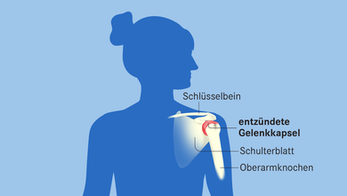 Eine Frozen Shoulder entsteht durch eine Entzündung der Schultergelenkkapsel.