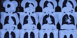 Aufnahmen eines Computertomographen zeigen zwei Lungenflügel