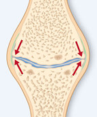 Die roten Pfeile zeigen die abgenutzten Stellen zwischen den zwei Knochen. Dort fehlt der Schutz durch Knorpel und Gelenkflüssigkeit