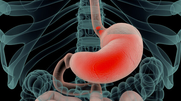 Wie Lange Dauert Eine Speiseröhrenentzündung www.apotheken-umschau.de