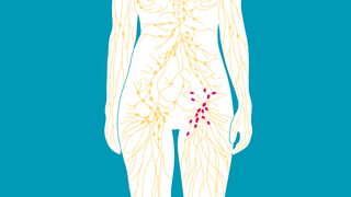 Schematische Darstellung von Lymphbahnen und Lymphknoten: In beiden Leisten finden sich Lymphknotengruppen. Die Knoten können sich aus verschiedenen Gründen vergrößern.