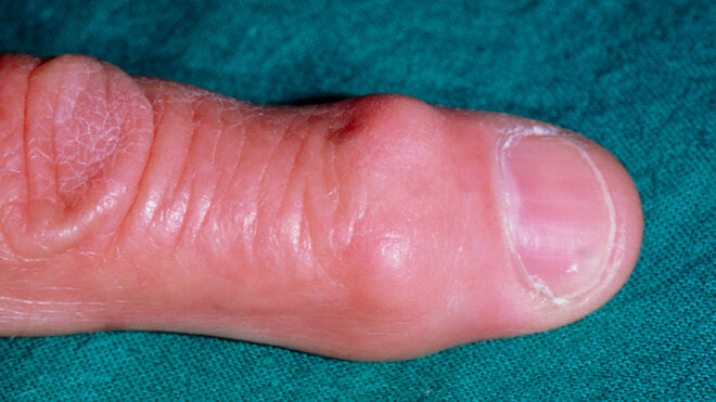 Heberden-Knoten am Endgelenk des Fingers bei Arthrose
