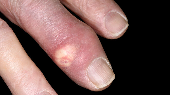 Bei Gicht bilden sich manchmal Gichtknoten am Finger, sogenannte Tophi.