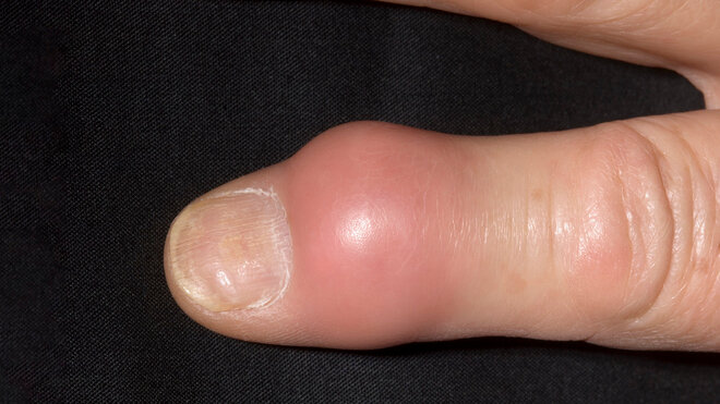 Bei einem Gichtanfall schwillt ein Fingergelenk plötzlich an, wird rot und schmerzt stark.