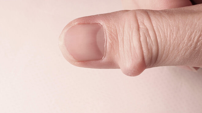 Ein Ganglion am Finger