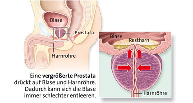 Das linke Bild zeigt die Prostata im männlichen Unterleib. Das rechte Bild zeigt die vergrößerte Prostata.
