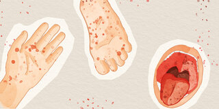 Eine Illustration zeigt eine Hand, einen Fuß und einen geöffneten Mund mit rotem Ausschlag.
