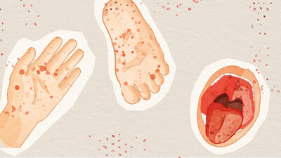 Eine Illustration zeigt eine Hand, einen Fuß und einen geöffneten Mund mit rotem Ausschlag.