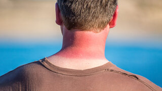 Ein Mann hat einen Sonnenbrand an Hals und Nacken.