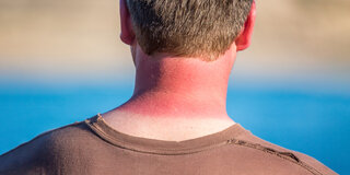 Ein Mann hat einen Sonnenbrand an Hals und Nacken.