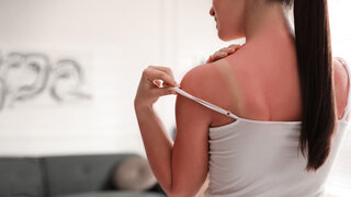 Eine Frau mit einem Sonnenbrand hebt den Träger ihres Tops an, sodass sich darunter ein weißer Streifen auf der Haut zeigt.