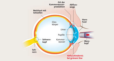Messung des Augeninnendrucks (Applanationstonometrie; schematisch; siehe Text oben)