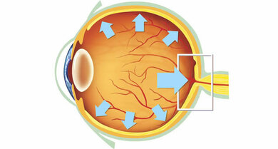Hauptrisikofaktor des Glaukoms: Ein zu hoher Augeninnendruck