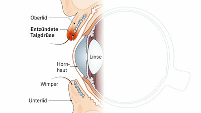 Entzündung des Augenlids (Schematische Darstellung)