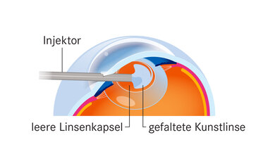Staroperation: In die leere Linsenkapsel wird eine Kunstlinse eingesetzt, die sich dort entfaltet.