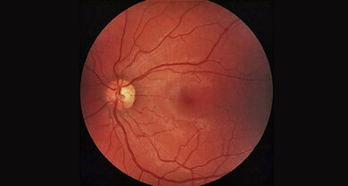 Netzhaut (Augenhintergrund, Normalbefund): Der rötliche Fleck in der Mitte entspricht dem Bereich der Makula