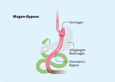 Beim Magenbypass wird der Magen zum größten Teil umgangen. Der Nahrungsbrei fließt fast direkt in den Dünndarm weiter.