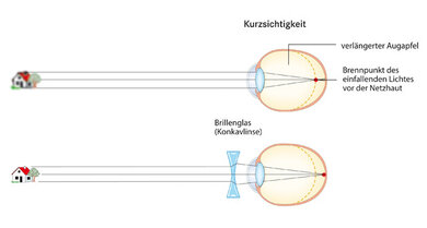 Korrektur der Kurzsichtigkeit mit einer Brille: Die Zerstreuungslinse verschiebt den Punkt an dem ein scharfes Bild entsteht auf die Netzhaut