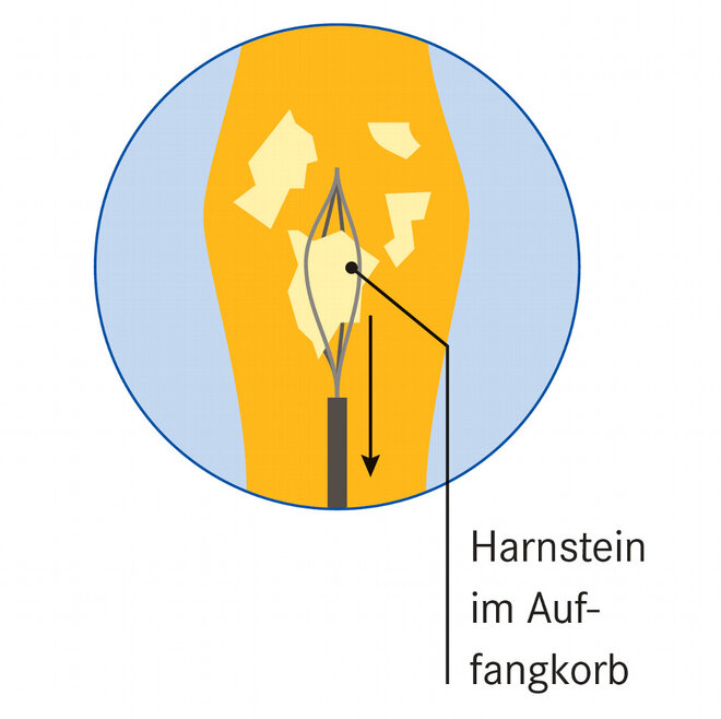 Infografik Harnstein im Auffangkorb