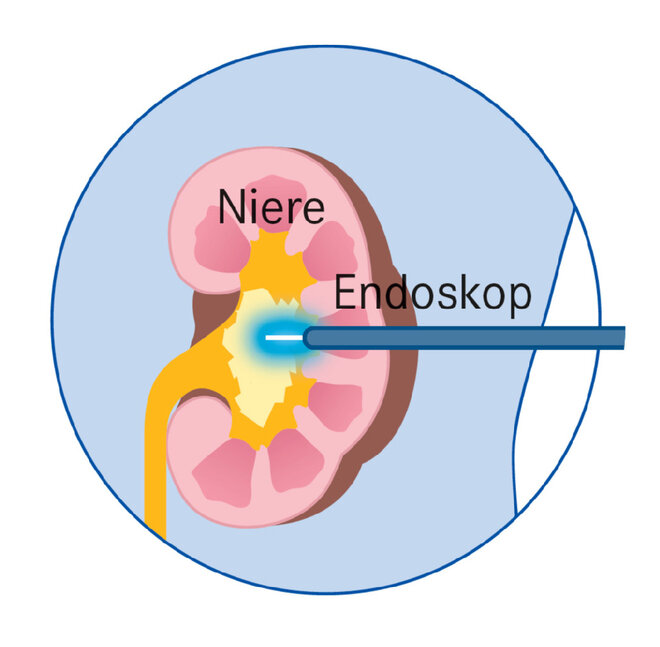 Infografik Niere Endoskop