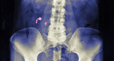 Steine können zum Beispiel auf einer Röntgenaufnahme sichtbar werden (links im Bild, rötlich eingefärbt)