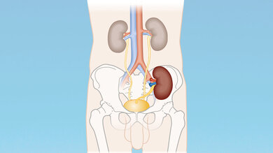 Lage der transplantierten Niere (im Bild dunkler gefärbt).