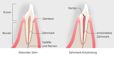 Eine unbehandelte Karies kann eine Zahnmark-Entzündung auslösen – besser bekannt als Wurzel-Entzündung.