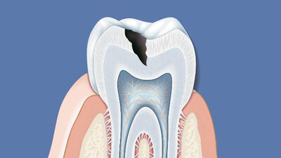 Kariesbefall, Zahnschmelz wird angegriffen