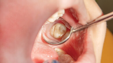 Karies am großen Backenzahn: Die Fissuren sind gelblich-kreidig. Durch das Zahnschmelz schimmert eine ovale, graue Stelle durch.
