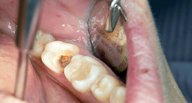 Fortschreitende Karies zerstört den Zahn und es kommt zu einem Loch im Zahn