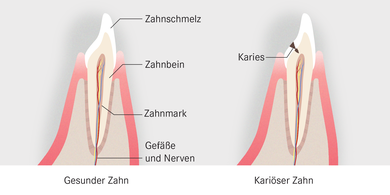 In der Regel fängt Karies im Zahnschmelz an und frisst sich mit der Zeit ins Zahnbein. Dort haben die Karies-Bakterien eine Verbindung zum Zahnmark.