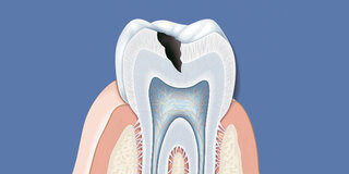 Kariesbefall, Zahnschmelz wird angegriffen