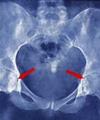 Röntgenbild einer Arthrose der Hüftgelenke