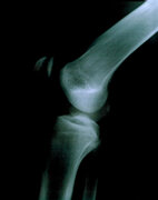 Durchleuchtet: Auf den Zustand des Knorpels lässt ein Röntgenbild nur indirekte Schlüsse zu, denn man sieht vor allem die Knochen