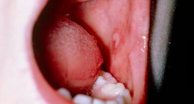 Mund im weißer punkt Hautdefekt im