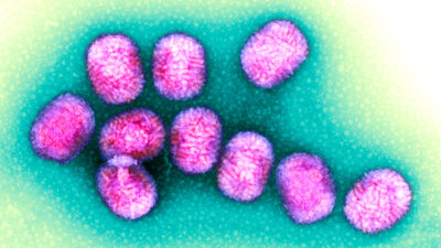 Auslöser von Dellwarzen sind Molluscum contagiosum-Viren. Sie gehören zur Familie der Pockenviren, gelten aber als harmlos.