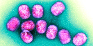 Auslöser von Dellwarzen sind Molluscum contagiosum-Viren. Sie gehören zur Familie der Pockenviren, gelten aber als harmlos.