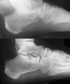 Röntgenaufnahme des Fußes: Der Fersensporn ist am Fersenbein erkennbar