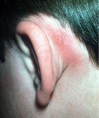 Mastoiditis: Die Haut hinter dem Ohr ist gerötet und druckempfindlich