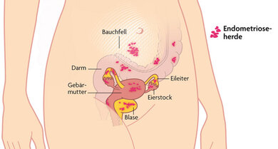 Die Grafik zeigt, wo sich Endometrioseherde zum Beispiel zeigen können